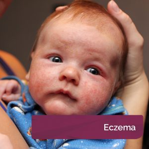AproDerm Eczema page link
