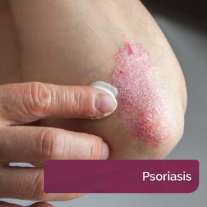 AproDerm Psoriasis page link