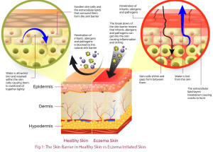 The Skin Barrier in Health Skin vs Eczema Irritated Skin
