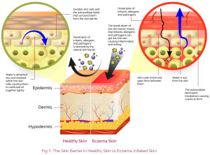 The Skin Barrier in healthy skin vs eczema irritated skin