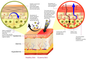Infographic for healthy skin compared to skin with Eczema