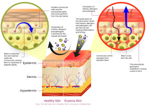 The Skin Barrier in Healthy skin vs Eczema irritated skin