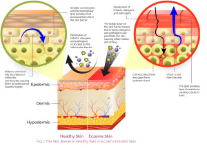 The Skin Barrier in Healthy Skin vs Eczema Irritated Skin