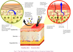 The Skin barrier in Healthy Skin vs Eczema Irritated Skin