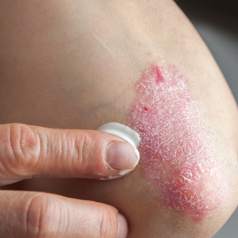 Affects around 2% of people in the UK...approximately 30-50% of adults with psoriasis develop it before they are 20 years